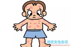 小兒水痘的治療方